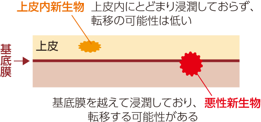 上皮内新生物：上皮内にとどまり浸潤しておらず、転移の可能性はない 悪性新生物：基底膜を越えて浸潤しており転移する可能性がある